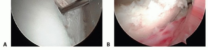 Relief for Posterior Shoulder Instability: Arthroscopic Treatment