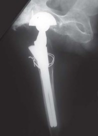 Illustration 39 for S-ROM: Inside the Technique of Modular Implant Design