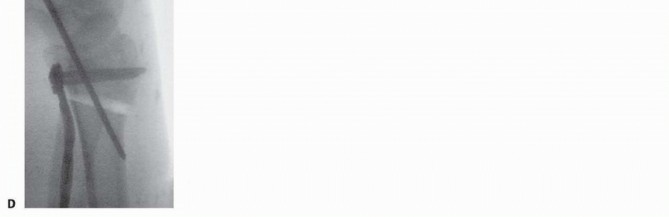 Illustration 22 for Precision Correction for Distal Radius Malunion