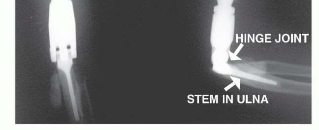 Illustration 3 for Distal Humeral Resection: Safe Techniques for Limb Preservation