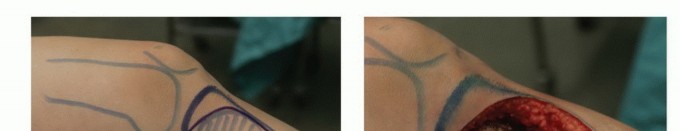 Illustration 2 for Avoid Major Surgery: Bone Tumor Treatment with Liquid Nitrogen Pour