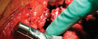 Illustration 28 for Cementless Femoral Stems: Master Indications & Avoid Pitfalls