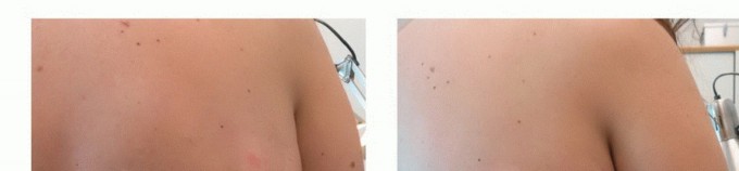 Illustration 15 for Targeted Ablation of Musculoskeletal Tumors: A Safer Approach