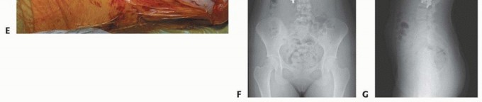Illustration 44 for Anterior Interbody Arthrodesis for Scoliosis: What You Need to Know