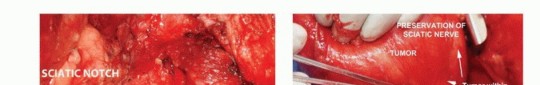 Illustration 14 for Beyond Hemipelvectomy: Preservation of the Sciatic in Buttock Surgery