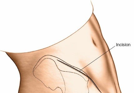 Illustration 23 for Pelvis & Acetabulum Approaches: Unlocking the Posterior Superior Iliac