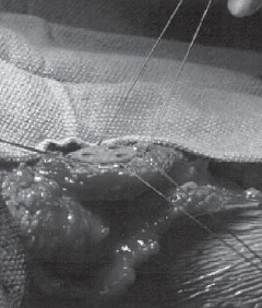 Illustration 17 for Solving Severe Bone Loss: Tantalum for Patellar Reconstruction