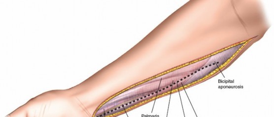 Illustration 94 for Mastering Approaches to the Upper Third of the Radius