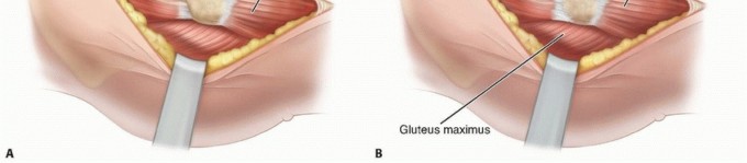 Illustration 21 for Septic Hip in Children: Mastering Anterior Drainage for Optimal Recovery