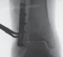 Illustration 37 for Optimal Fixation of the Ankle: Open Reduction & Internal Fixation
