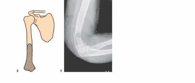 Illustration 5 for Restore Vital Function: Surgery for Type II Humeral Metastasis