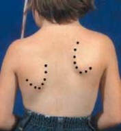 Mastering the Modified Woodward: Repair of Sprengel Deformity