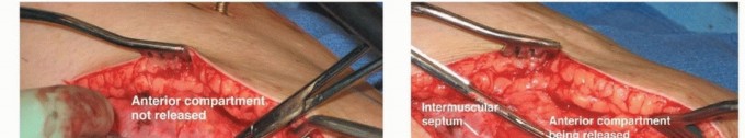 Illustration 11 for Acute Compartment Syndrome: Timely Fasciotomy Explained