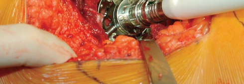 Illustration 57 for Direct Lateral Hip: Optimize Exposure with Sharp Curved Hohmann