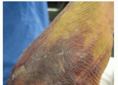 Elbow Replacement for Acute Trauma