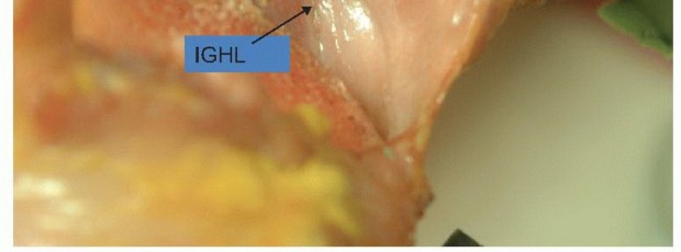 Illustration 2 for Regain Stability: Arthroscopy for Anterior Instability & the Inferior Glenohumeral Ligament
