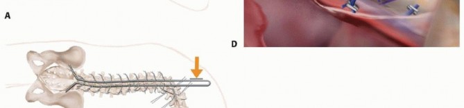 Illustration 9 for Duchenne Muscular Dystrophy: Is Spinal Fusion the Answer?