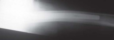 Illustration 69 for S-ROM: Inside the Technique of Modular Implant Design