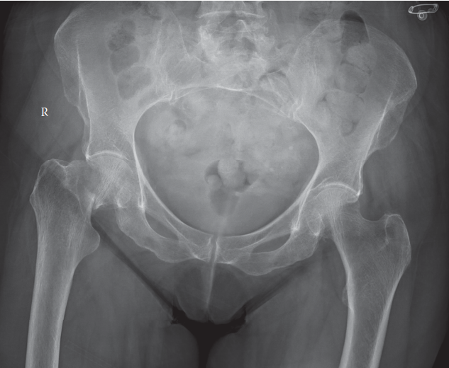 Hip Fracture: Essential Clinical Insights for Managing the Injured Hip