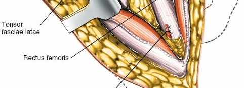 Illustration 39 for Unlocking Every Aspect of the Hip's Surgical Approaches