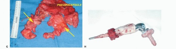 Illustration 90 for Advanced Distal Femoral Resections: Limb-Sparing Outcomes & Techniques