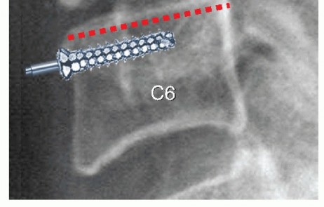 Illustration 13 for How ACDF Clears Your Posterior Disc Space for Lasting Relief