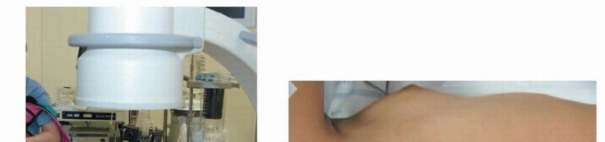 Illustration 7 for Anterior Interbody Arthrodesis for Scoliosis: What You Need to Know