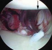Illustration 14 for Regain Stability: Anterior Shoulder Instability Arthroscopic Fix