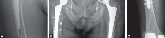 Illustration 23 for Mastering Fractures After Total Hip Arthroplasty