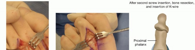 Illustration 4 for Toe Deformity Pain? Rebalance Flexor to Extensor for Relief