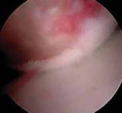 Illustration 8 for Regain Stability: Anterior Shoulder Instability Arthroscopic Fix