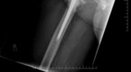 Illustration 4 for Solving Severe Acetabular Bone Loss with Cup-Cage Reconstruction