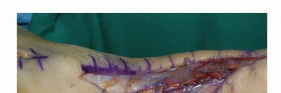 Torn Tibialis Anterior Rupture? Effective Treatment Options