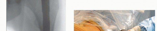 Illustration 25 for Achieve Optimal Femoral Head Fixation with Cephalomedullary Nailing