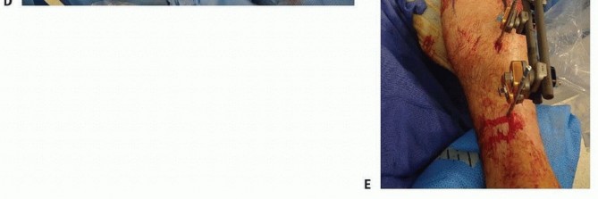 Illustration 42 for Tibia External Fixation: See How Pins Are Placed for Healing