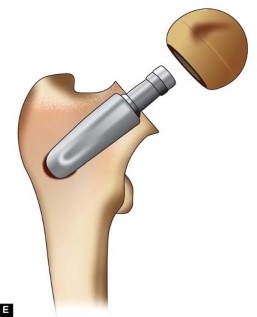 Illustration 51 for The Silent Hip: Achieving a Truly Silent, Pain-Free Joint