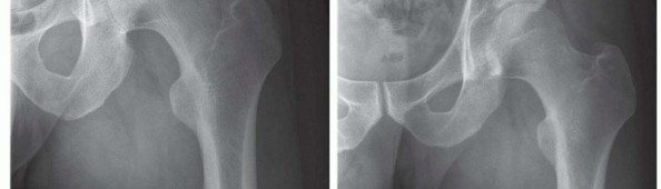 Illustration 10 for Hip Arthroscopy: Your Minimally Invasive Solution for Hip Pain