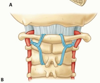 Illustration 32 for Addressing Cervical Spine Instability with Posterior Arthrodesis