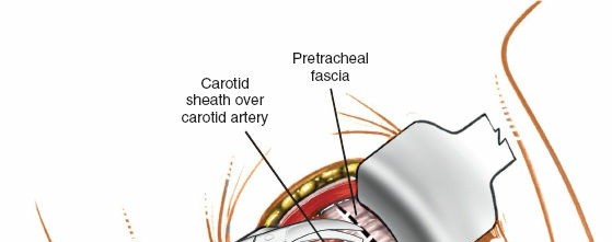 Illustration 242 for Approach to the Lumbar Spine: Mastering Techniques & Anatomy
