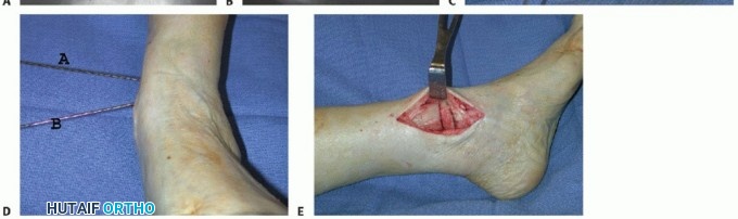 Illustration 4 for Unlock Ankle Preservation: Supramalleolar Closing Wedge Osteotomy