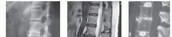 Illustration 3 for Anterior Lumbar Interbody: Fusion, Disc Replacement & Pain Relief