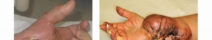 Illustration 6 for Above-Elbow & Below-Elbow Amputations: When & Why They're Needed