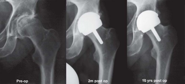 Illustration 114 for Birmingham Hip Resurfacing Designer's Technique for Active Lives
