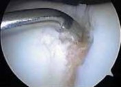 Illustration 11 for Microfracture Chondroplasty: How Tiny Holes Are Made to Fix Cartilage
