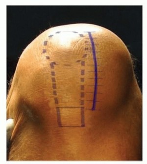 صورة توضيحية لـ استبدال مفصل الركبة الجزئي: حل متقدم لآلام الركبة المستمرة مع الأستاذ الدكتور محمد هطيف