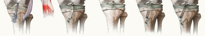 Illustration 8 for Optimizing ACL Reconstruction for Skeletally Immature Patients