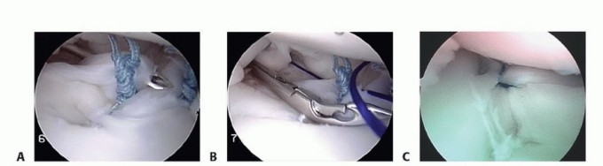 Illustration 30 for Regain Stability: Arthroscopy for Anterior Instability & the Inferior Glenohumeral Ligament