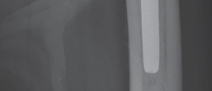 Illustration 41 for Femoral Stem Revision: Posterior Approach for Better Outcomes