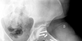 Illustration 10 for Conservative Head Reduction Osteotomy: Restoring Young Hip Function