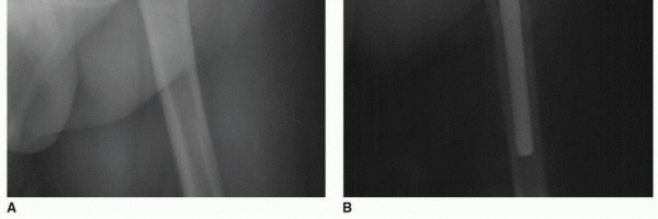 Illustration 10 for Overcoming Proximal Femoral Deformity in THA: Key Strategies